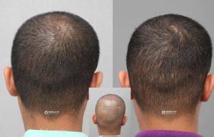 Cấy tóc FUE 3400 nang điều hói đỉnh đầu - case 78