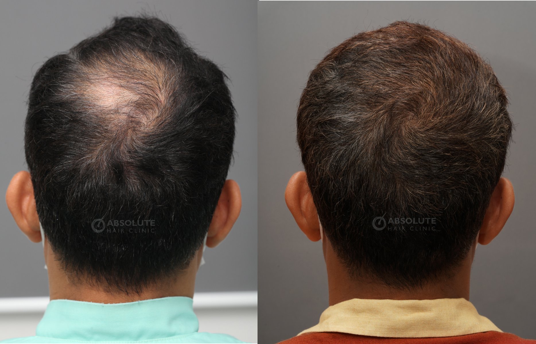 Cấy tóc FUE 3300 nang, kết quả sau 7 tháng - case 82