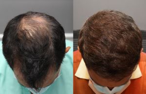 Cấy tóc FUE 3300 nang, kết quả sau 7 tháng - case 82