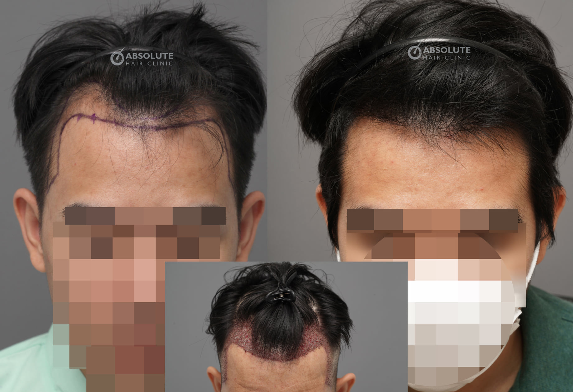 Cấy tóc FUE 2100 nang trị hói chữ M sau 5 tháng - case 83