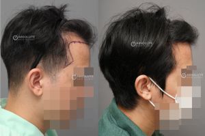 Cấy tóc FUE 2100 nang trị hói chữ M sau 5 tháng - case 83