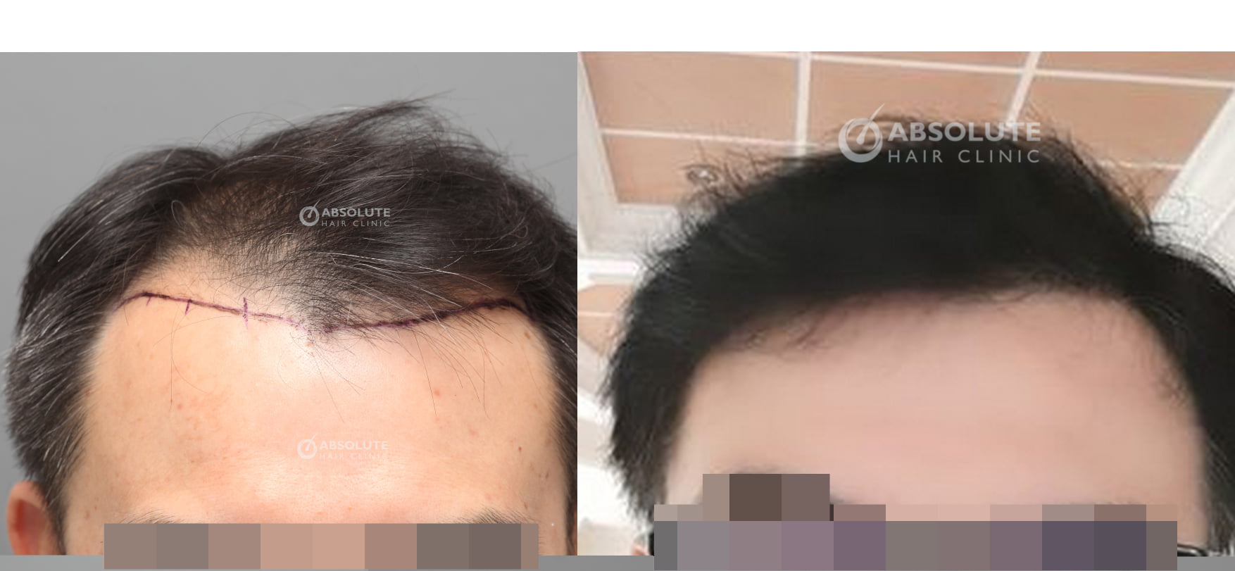 Cấy tóc 3000 nang sau 7 tháng, kỹ thuật FUE - case 84