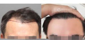 Cấy tóc 3000 nang sau 7 tháng, kỹ thuật FUE - case 84