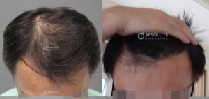 Cấy tóc 3000 nang sau 7 tháng, kỹ thuật FUE - case 84