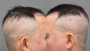 Cấy tóc 3000 nang sau 7 tháng, kỹ thuật FUE - case 84