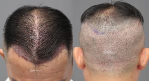 Cấy tóc 3000 nang sau 7 tháng, kỹ thuật FUE - case 84