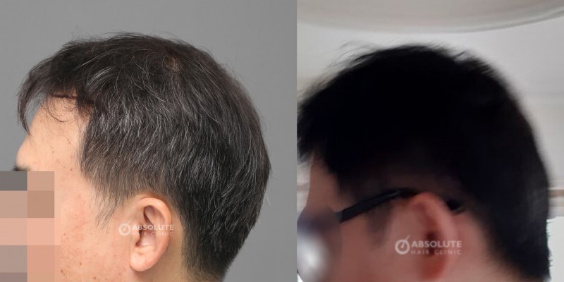 Cấy tóc 3000 nang sau 7 tháng, kỹ thuật FUE - case 84
