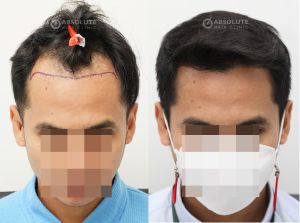 Cấy tóc FUE 2350 nang tóc điều trị hói chữ M, kết quả sau 7 tháng - case 85