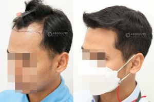 Cấy tóc FUE 2350 nang tóc điều trị hói chữ M, kết quả sau 7 tháng - case 85