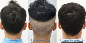 Cấy tóc FUE 2350 nang tóc điều trị hói chữ M, kết quả sau 7 tháng - case 85