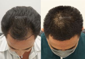 Cấy tóc FUE 2540 nang kết quả sau 7 tháng - case 86