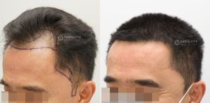 Cấy tóc FUE 2540 nang kết quả sau 7 tháng - case 86