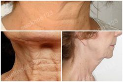 Phân loại cổ lão hóa theo Dedo