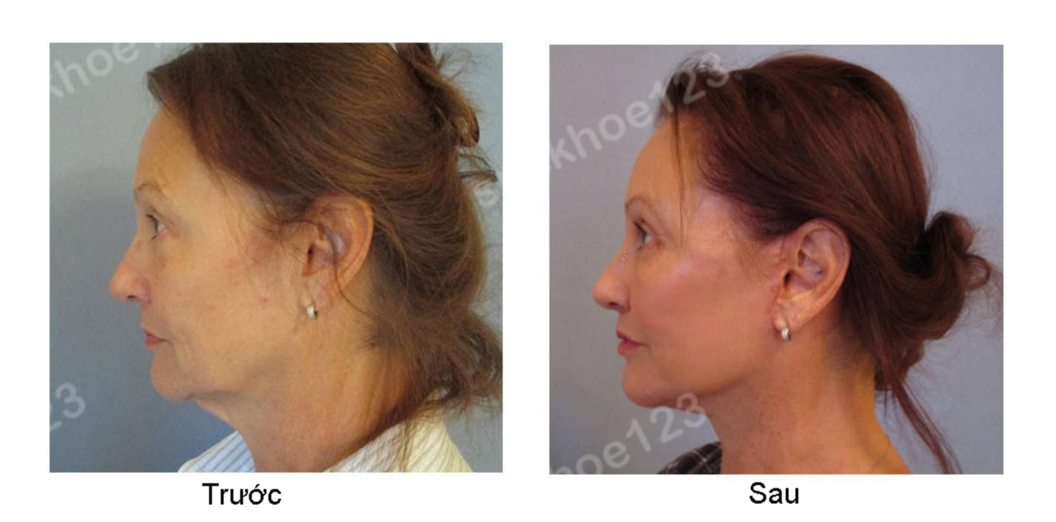 HIGH SMAS cut