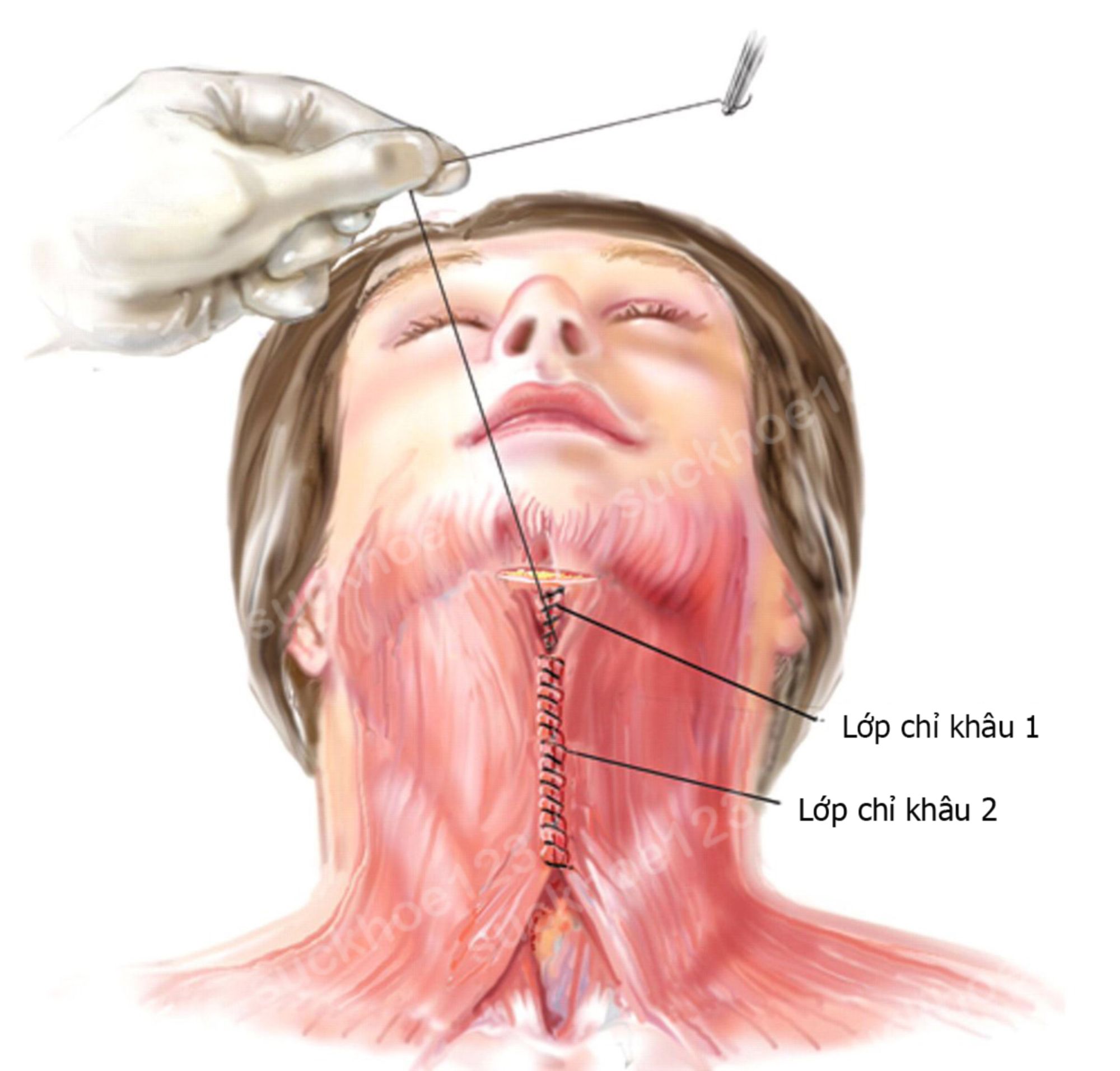 khâu thắt cơ giữa cổ