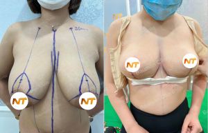 Thu nhỏ ngực nữ 37 tuổi Hải Phòng - ca 54