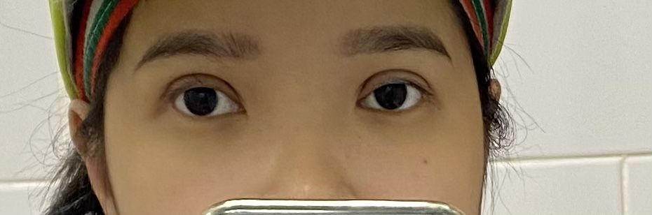 Mí mắt cao sau khi cắt mí Mí mắt cao sau khi cắt mí