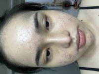 Nâng mũi gần 1 tháng vẫn căng tức và tê hết 2 má và môi Nâng mũi gần 1 tháng vẫn căng tức và tê hết 2 má và môi