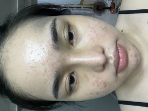 Nâng mũi gần 1 tháng vẫn căng tức và tê hết 2 má và môi