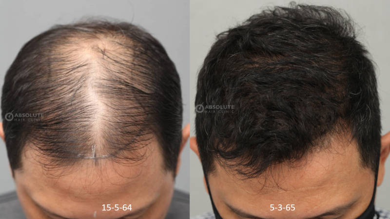Cấy 4200 nang tóc kỹ thuật FUE sau 10 tháng - case 100