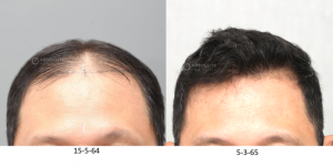 Cấy 4200 nang tóc kỹ thuật FUE sau 10 tháng - case 100