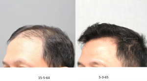 Cấy 4200 nang tóc kỹ thuật FUE sau 10 tháng - case 100