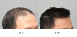 Cấy 4200 nang tóc kỹ thuật FUE sau 10 tháng - case 100