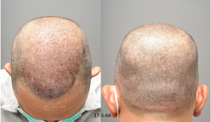 Cấy 4200 nang tóc kỹ thuật FUE sau 10 tháng - case 100