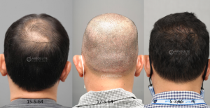 Cấy 4200 nang tóc kỹ thuật FUE sau 10 tháng - case 100