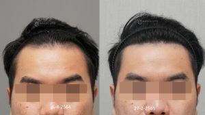 Cấy tóc FUE 2000 nang, kết quả sau 10 tháng - case 102
