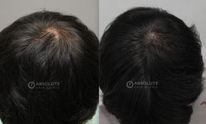 Cấy tóc FUE 1100 nang sau 9 tháng - case 106