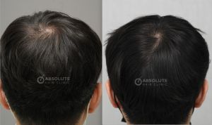 Cấy tóc FUE 1100 nang sau 9 tháng - case 106