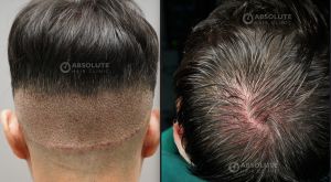 Cấy tóc FUE 1100 nang sau 9 tháng - case 106