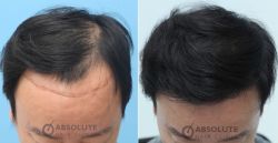 Hướng dẫn chuẩn bị trước cấy tóc FUE