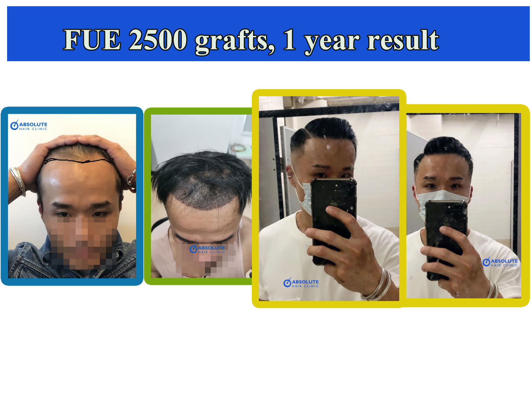 Cấy tóc FUE 2500 nang, kết quả sau 1 năm - case 75
