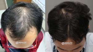 Cấy 2786 nang tóc, kỹ thuật FUE, kết quả sau 11 tháng - case 79