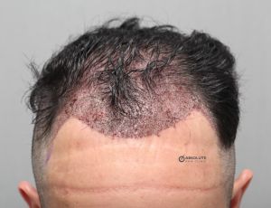 Cấy 2786 nang tóc, kỹ thuật FUE, kết quả sau 11 tháng - case 79