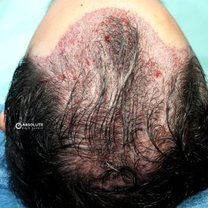 Cấy 2786 nang tóc, kỹ thuật FUE, kết quả sau 11 tháng - case 79