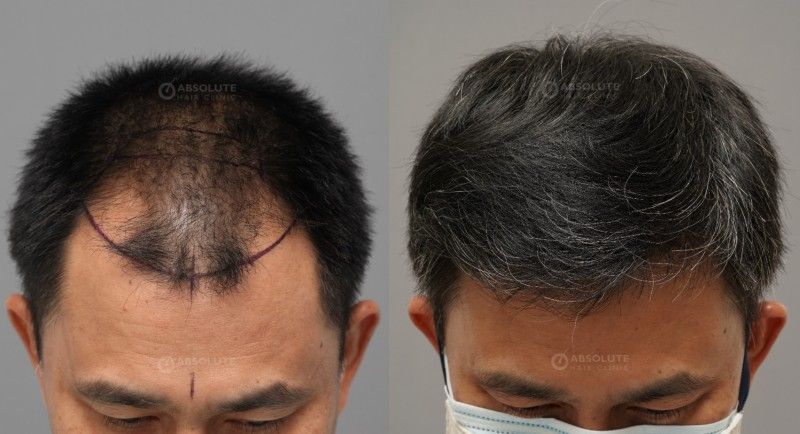 Cấy tóc 3225 nang, kỹ thuật FUE sau 8 tháng - case 90