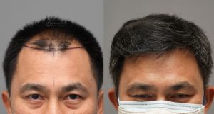 Cấy tóc 3225 nang, kỹ thuật FUE sau 8 tháng - case 90