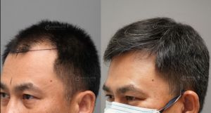 Cấy tóc 3225 nang, kỹ thuật FUE sau 8 tháng - case 90