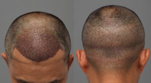 Cấy tóc 3225 nang, kỹ thuật FUE sau 8 tháng - case 90