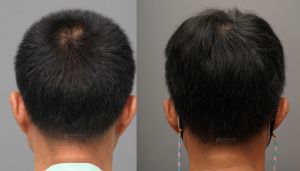 Cấy tóc 3225 nang, kỹ thuật FUE sau 8 tháng - case 90