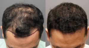 Cấy tóc FUE 3400 nang, kết quả sau 8 tháng - case 94