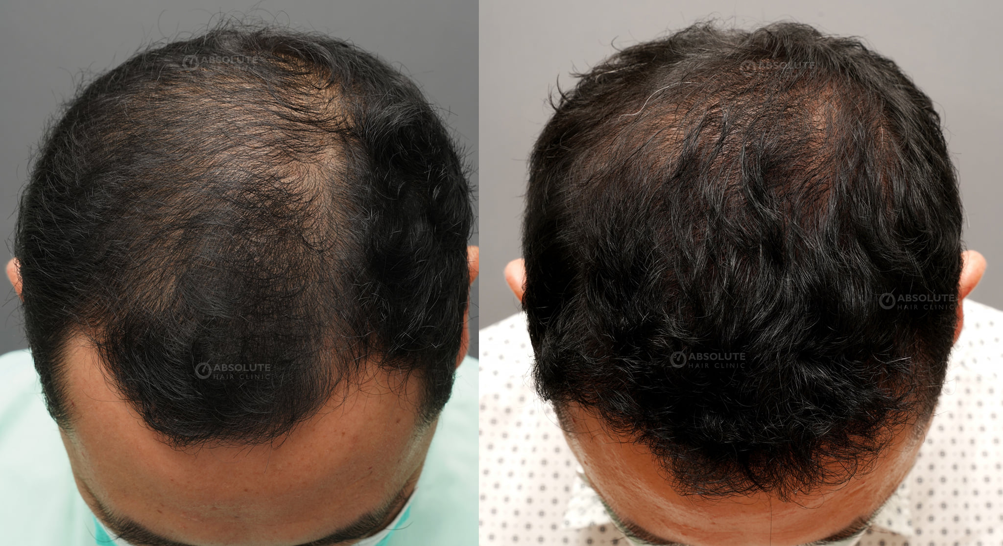 Cấy tóc FUE 3400 nang, kết quả sau 8 tháng - case 94