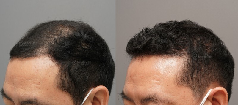 Cấy tóc FUE 3400 nang, kết quả sau 8 tháng - case 94