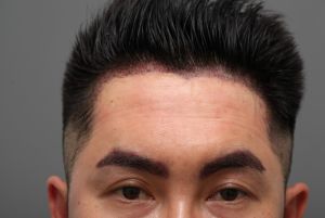 Cấy tóc 1300 nang và cấy lông mày 300 nang - case 95