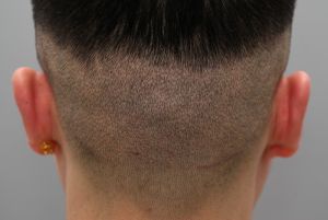 Cấy tóc 1300 nang và cấy lông mày 300 nang - case 95