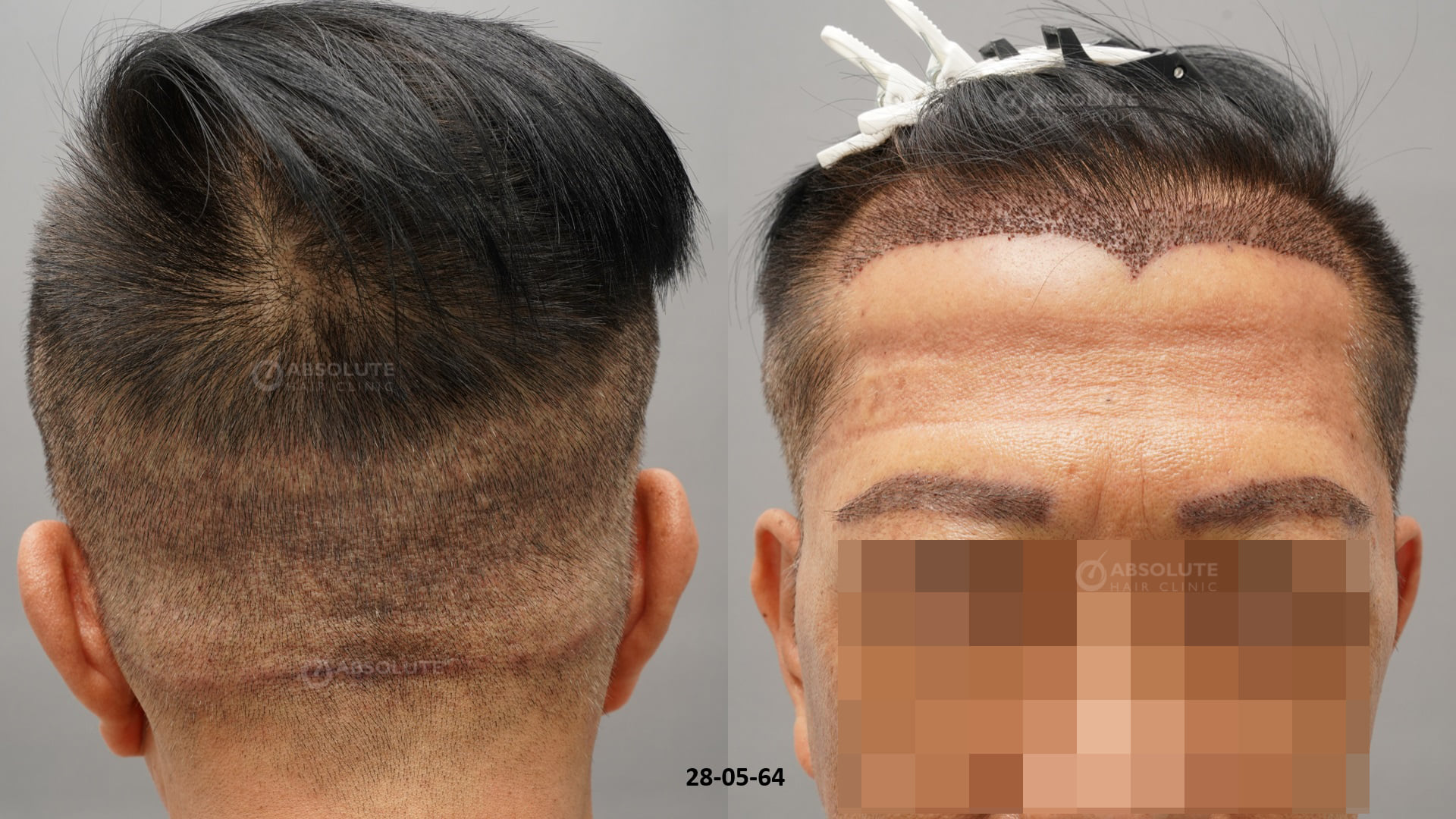 Hình ảnh Cấy tóc: Cấy tóc và cấy lông mày sau 7 tháng - case 97 - Viện Cấy  Tóc Absolute Hair Clinic