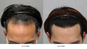 Cấy tóc FUE 2500 nang, kết quả sau 10 tháng - case 98